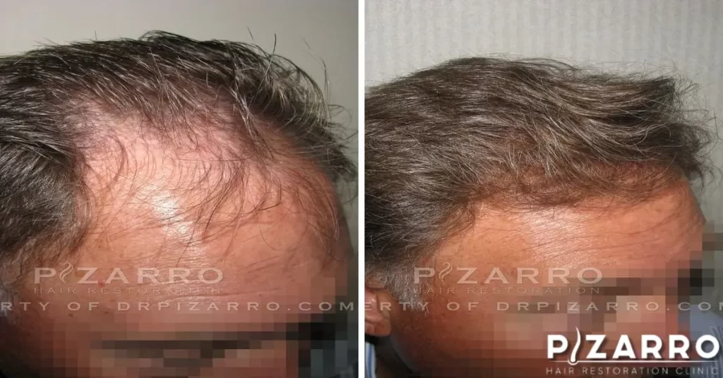 before and After of Hair Restoration from Pizarro Hair Restoration Clinic